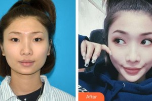 深圳愛爾眼科醫(yī)院李雙農整形價格表附開內眼角案例展示