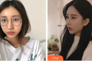 深圳愛爾眼科醫(yī)院夏娟整形價格表附內切祛眼袋案例展示