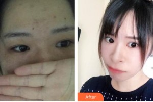 深圳愛爾眼科醫(yī)院鄧宏偉整形價格表附定點雙眼皮案例展示