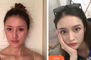 深圳德視佳眼科門診部張平整形價格表附下瞼整形案例展示