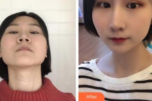 深圳愛爾眼科醫(yī)院常征整形價格表附眼部綜合案例展示