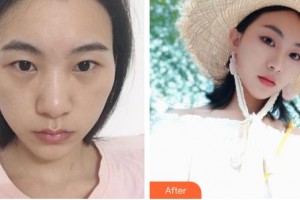 深圳愛爾眼科醫(yī)院金童實整形價格表附眼部綜合案例展示