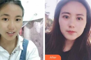 深圳愛爾眼科醫(yī)院慕明燕整形價格表附切開雙眼皮案例展示