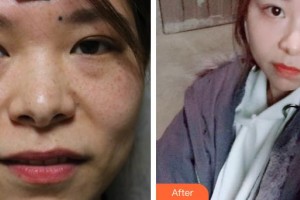 深圳市眼科醫(yī)院聞慧整形價格表附激光去眼袋案例展示