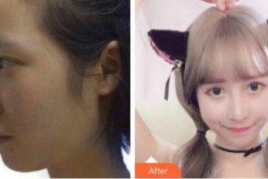 深圳愛爾眼科醫(yī)院徐超然整形價格表附切開雙眼皮案例展示