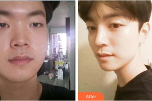 深圳愛爾眼科醫(yī)院易細(xì)香整形價格表附眼部綜合案例展示