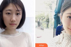 深圳愛爾眼科醫(yī)院楊化學(xué)整形價格表附定點雙眼皮案例展示