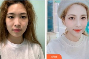 深圳愛爾眼科醫(yī)院周月芷整形價格表附眼部綜合案例展示