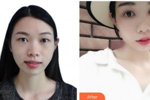 深圳?，斄猪槼毖劭漆t(yī)院施禮康整形價(jià)格表附切開雙眼皮案例展示