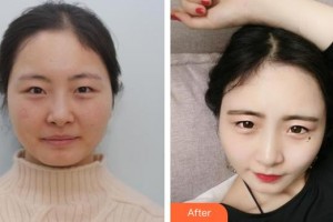 深圳?，斄猪槼毖劭漆t(yī)院肖月影整形價格表附眼部修復(fù)案例展示