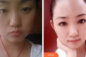 深圳愛爾眼科醫(yī)院邵嵐整形價(jià)格表附切開雙眼皮案例展示