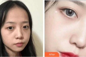 深圳?，斄猪槼毖劭漆t(yī)院哈斯?fàn)栒蝺r(jià)格表附切開雙眼皮案例展示