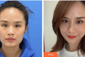 深圳?，斄猪槼毖劭漆t(yī)院萬竹整形價(jià)格表附激光去眼袋案例展示