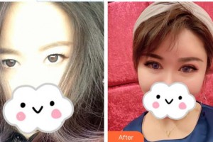 深圳?，斄猪槼毖劭漆t(yī)院劉泉整形價(jià)格表附眼部綜合案例展示