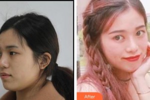 深圳?，斄猪槼毖劭漆t(yī)院尉洋整形價(jià)格表附眼部綜合案例展示