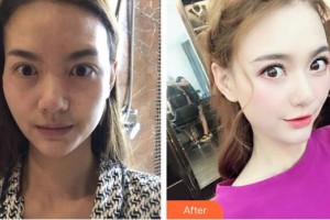 深圳?，斄猪槼毖劭漆t(yī)院袁野整形價(jià)格表附眼部修復(fù)案例展示