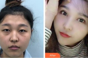 深圳希瑪林順潮眼科醫(yī)院林小銘整形價(jià)格表附眼部綜合案例展示