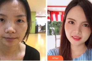 深圳?，斄猪槼毖劭漆t(yī)院舒敏整形價(jià)格表附切開雙眼皮案例展示