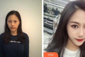 深圳希瑪林順潮眼科醫(yī)院石峰整形價(jià)格表附眼部修復(fù)案例展示