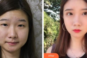 深圳華夏眼科醫(yī)院劉暢整形價(jià)格表附切開雙眼皮案例展示