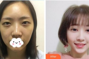 深圳華夏眼科醫(yī)院成洪波整形價(jià)格表附眼部綜合案例展示