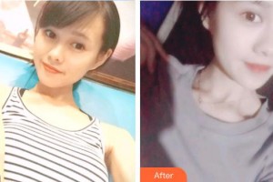 深圳?，斄猪槼毖劭漆t(yī)院江英整形價(jià)格表附開內(nèi)眼角案例展示