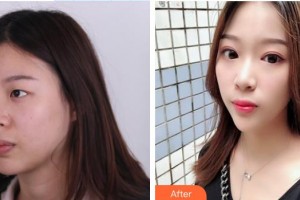 深圳華夏眼科醫(yī)院姚穎整形價(jià)格表附雙眼皮案例展示