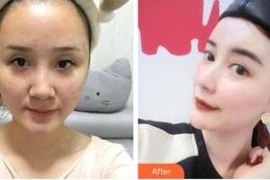 懷化市第一人民醫(yī)院史萍整形價(jià)格表附鼻部綜合案例展示