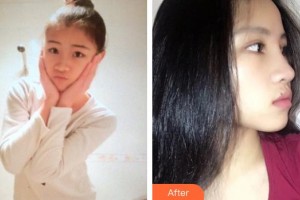 懷化市第一人民醫(yī)院申志云整形價(jià)格表附鼻部綜合案例展示