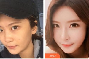 懷化市第一人民醫(yī)院稅永剛整形價(jià)格表附鼻部綜合案例展示