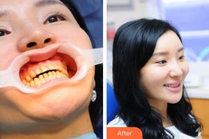 東莞特美口腔門診部王濟(jì)良整形價(jià)格表附美白貼片案例展示