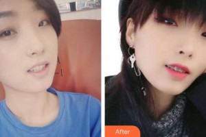 東莞特美口腔門診部郭憲碧整形價(jià)格表附金屬托槽矯正案例展示