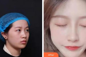 東莞百佳瑪麗亞婦產醫(yī)院金哉勛整形價格表附鼻部綜合案例展示