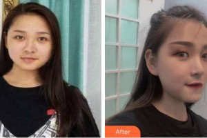 東莞君熠醫(yī)療美容診所丁潔整形價格表附鼻部綜合案例展示