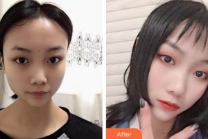 東莞百佳瑪麗亞婦產(chǎn)醫(yī)院李雪琴整形價(jià)格表附鼻部綜合案例展示