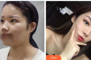 東莞西妃醫(yī)療美容醫(yī)院任家驃整形價(jià)格表附鼻部綜合案例展示