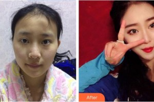 東莞百佳瑪麗亞婦產(chǎn)醫(yī)院謝本勇整形價(jià)格表附鼻部綜合案例展示