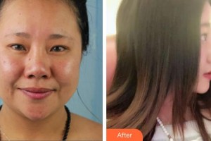 東莞華美醫(yī)療美容醫(yī)院羅日云整形價(jià)格表附鼻部綜合案例展示