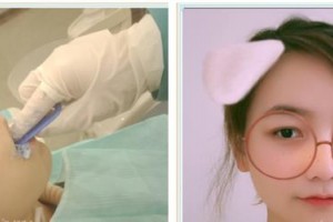 東莞同濟(jì)光華醫(yī)院口腔科譚娟玲整形價(jià)格表附牙齒隱形矯正案例展示