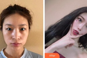 東莞華廈眼科醫(yī)院袁進整形價格表附眼部綜合案例展示