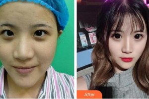 東莞華廈眼科醫(yī)院陳國謀整形價格表附開內眼角案例展示