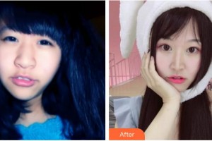 東莞華廈眼科醫(yī)院羅建整形價格表附眼部綜合案例展示