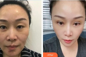 東莞愛爾眼科醫(yī)院華山整形價格表附切眉術案例展示