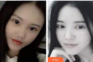 東莞愛爾眼科醫(yī)院陳曉蓓整形價格表附激光去眼袋案例展示