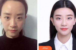 東莞華廈眼科醫(yī)院姚立平整形價格表附埋線雙眼皮案例展示