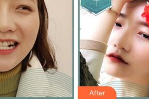 東莞南城固德口腔門診部董毅整形價格表附牙貼面案例展示