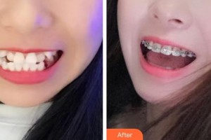 東莞南城固德口腔門診部陳哲良整形價格表附金屬托槽矯正案例展示