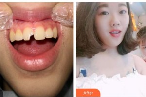 東莞恒生口腔門診部張業(yè)俊整形價格表附美白貼片案例展示