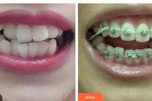 東莞臺心醫(yī)院口腔科曾思整形價格表附金屬托槽矯正案例展示