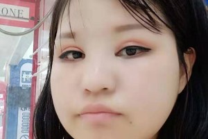 上海時光整形外科醫(yī)院下頜角手術(shù)果太好了